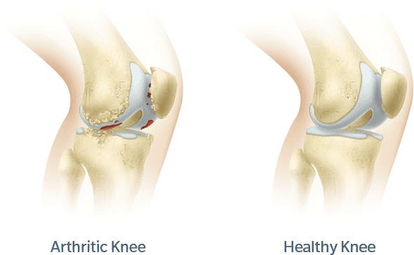Knee